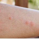 5 medicinal plants to relieve insect bites