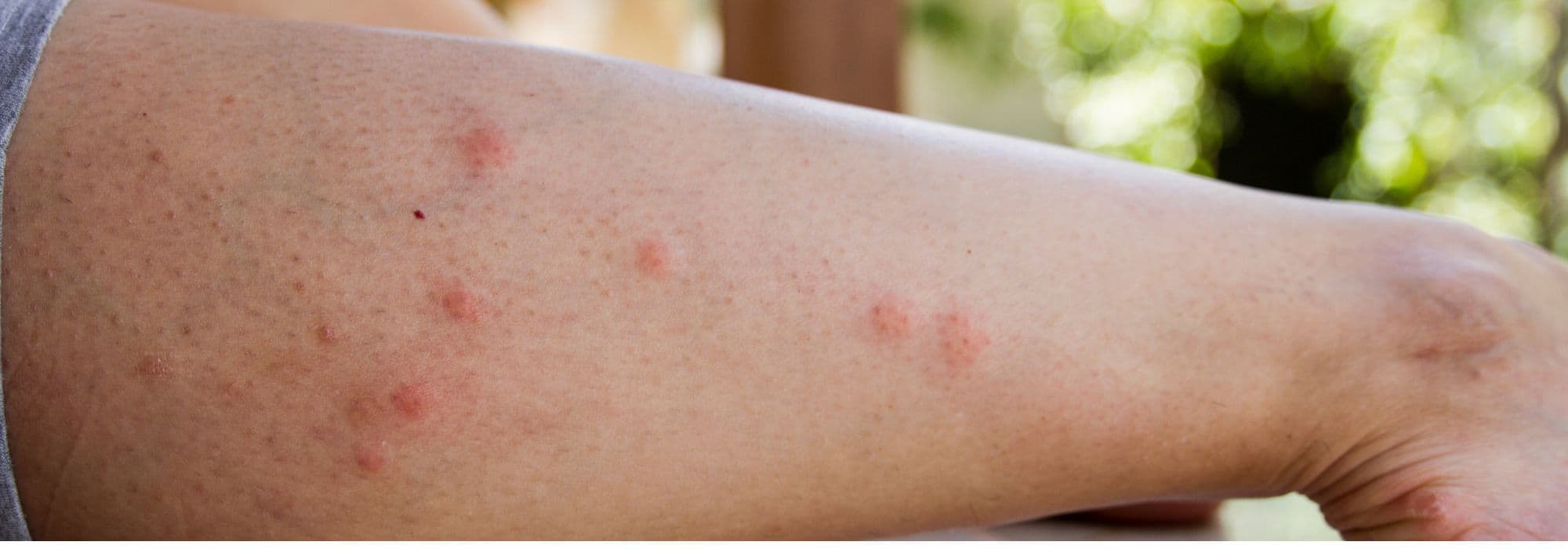 5 medicinal plants to relieve insect bites